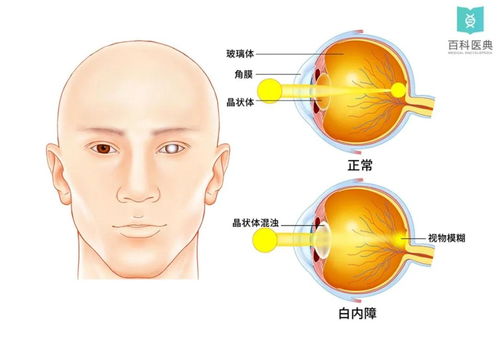 恼人的白内障,烦人的 雾中花