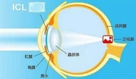 科学矫正近视与弱视 三种核心干预方式详解